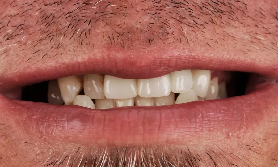 After: the same smile restored with crowns and bridges.