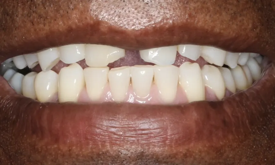 Before: a smile with chips and gaps.