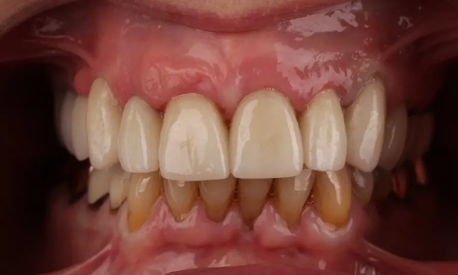 After: natural-looking crowns and even gum heights.