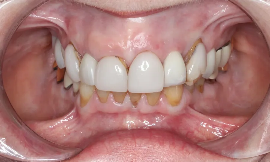 Before: old crowns with decay and uneven gums.