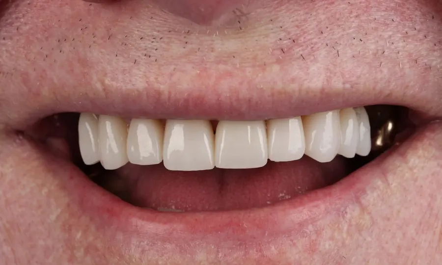 After: white, aligned teeth after treatment.