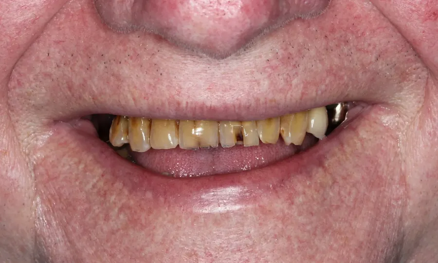 Before: yellowed, cracked and stained teeth.