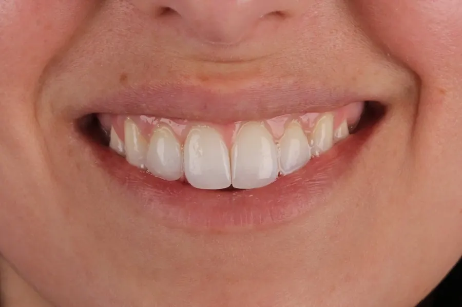A natural-looking smile restored at Kerst & Caskey.