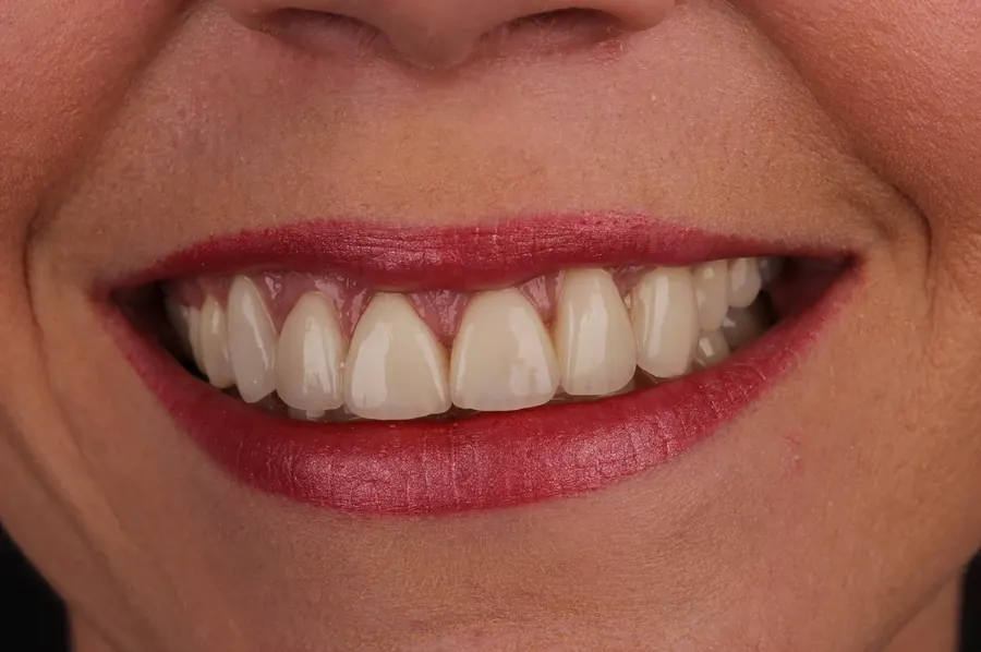 A smile after porcelain veneers with Dr. Jeffrey Kerst.